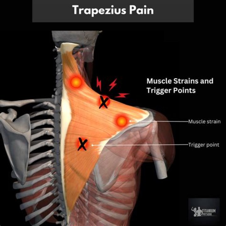 Can sleeping wrong cause trapezius pain?