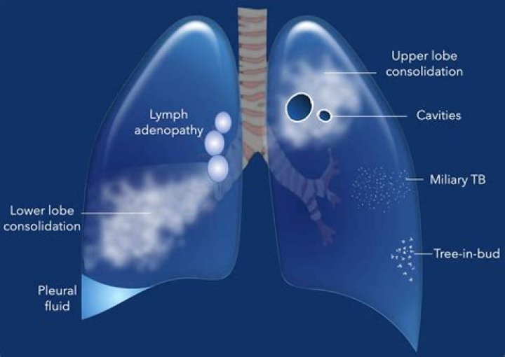 Can TB cause MS?