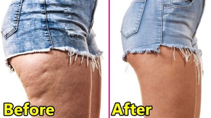 Can thigh cellulite go away?