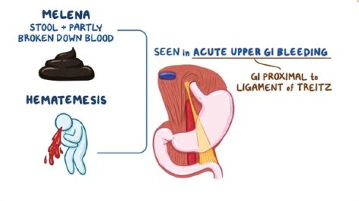 Can upper GI bleeding cause Hematochezia?