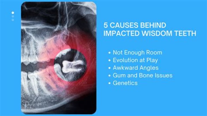 Can wisdom teeth affect ears?