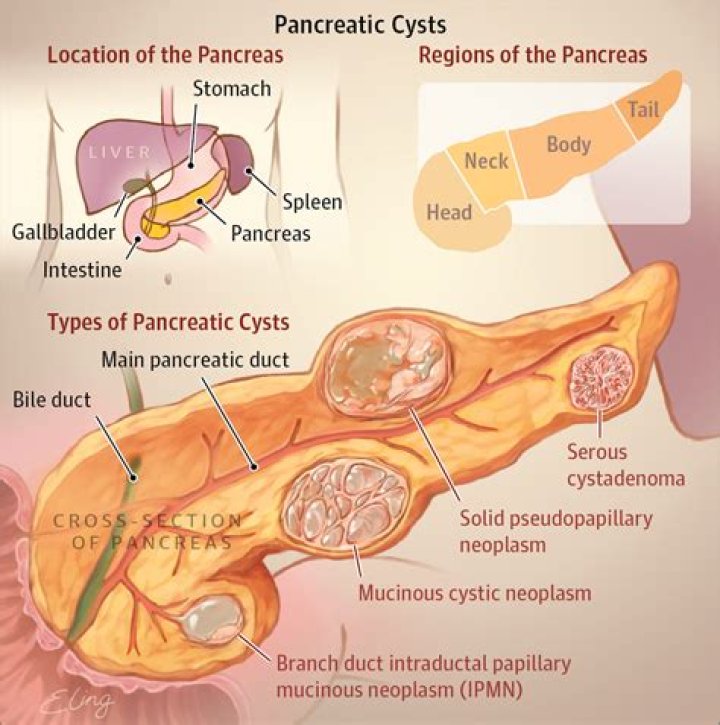 Can you aspirate pancreatic cyst?
