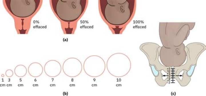 Can you be 1 cm dilated at 36 weeks?