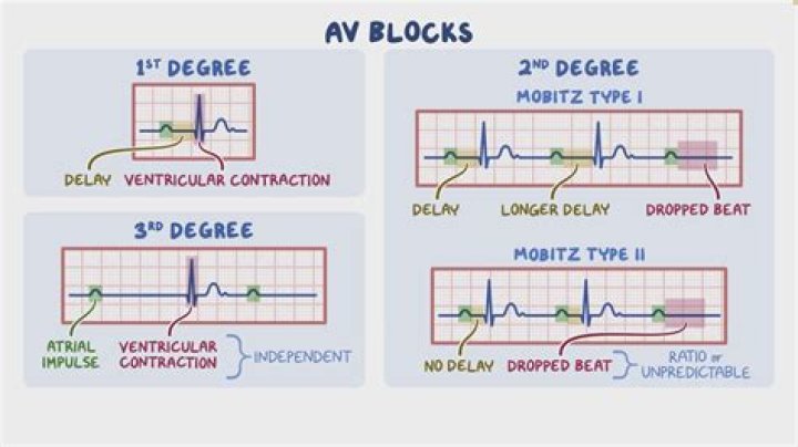 Can you Cardiovert complete heart block?