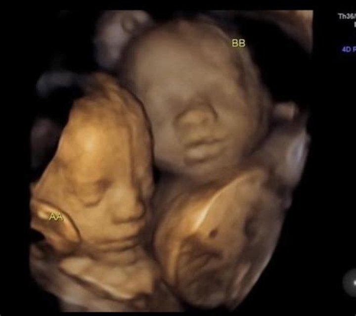 Can you do a 3D ultrasound at 16 weeks?