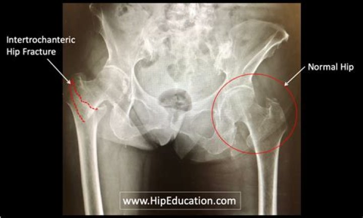 Can you fracture your hip and still walk on it?