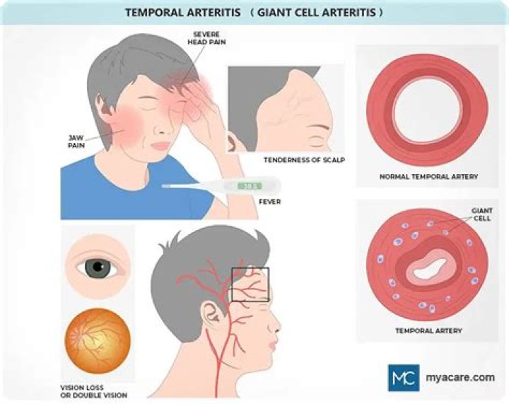 Can you go blind from temporal arteritis?