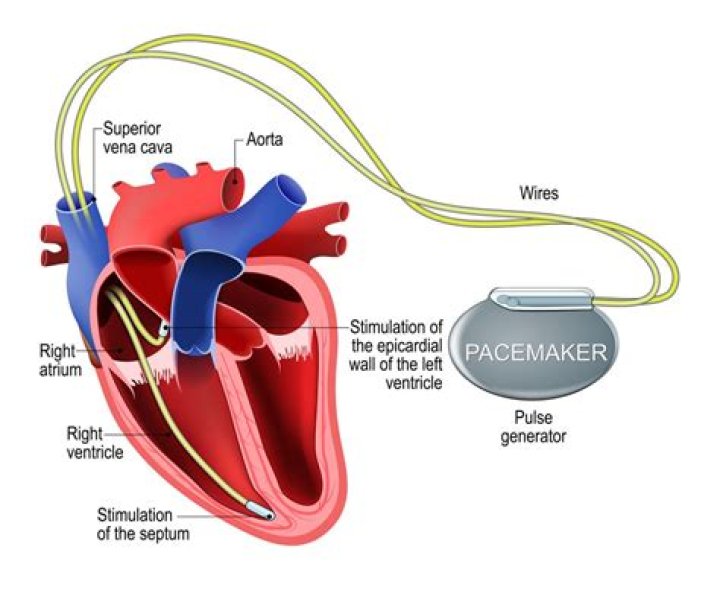 Can you have an MRI with pacing wires in?
