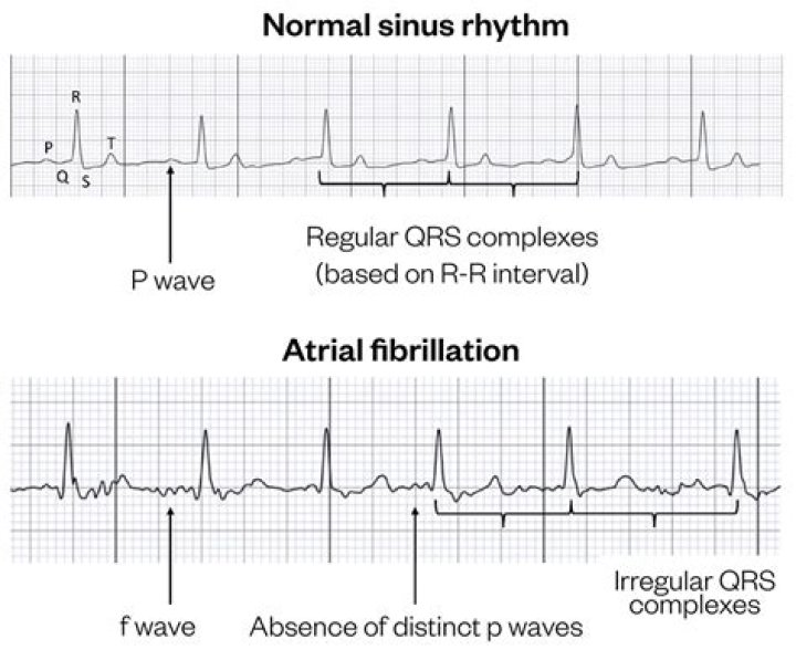 Can you have sinus rhythm with LBBB?