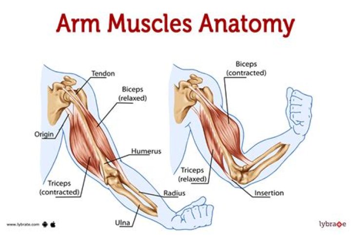 Can you pull a muscle sleeping on your arm?