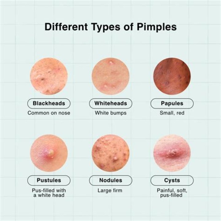 Can you put Benadryl on a pimple?