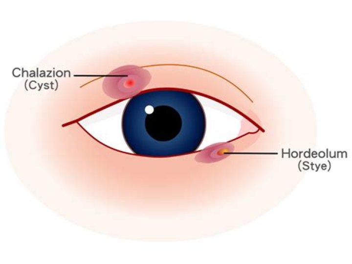 Can you put ice on a chalazion?