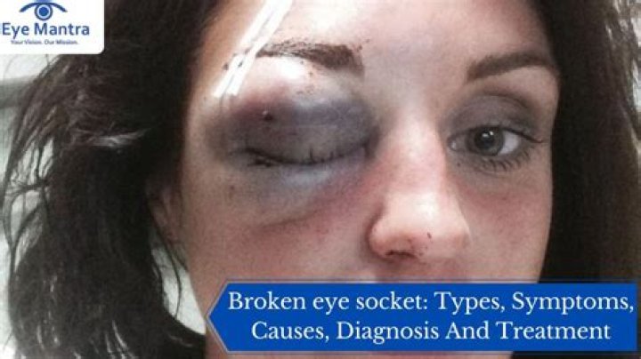 Can you recover from a broken eye socket?