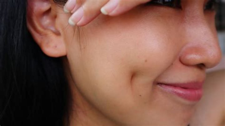 Can you remove a dimple?