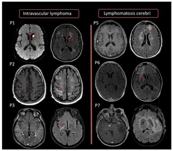Can you see PML on CT scan?