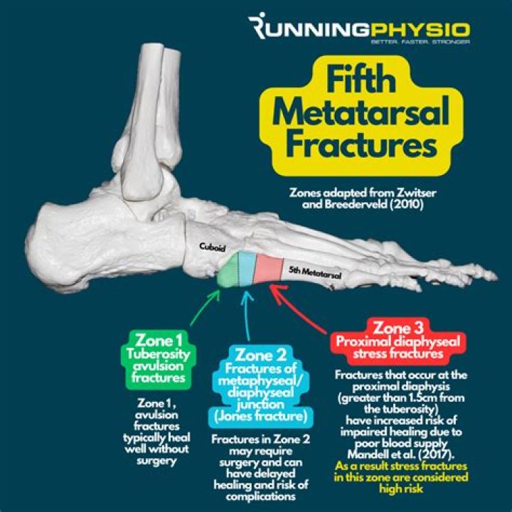 Can you sprain 5th metatarsal?