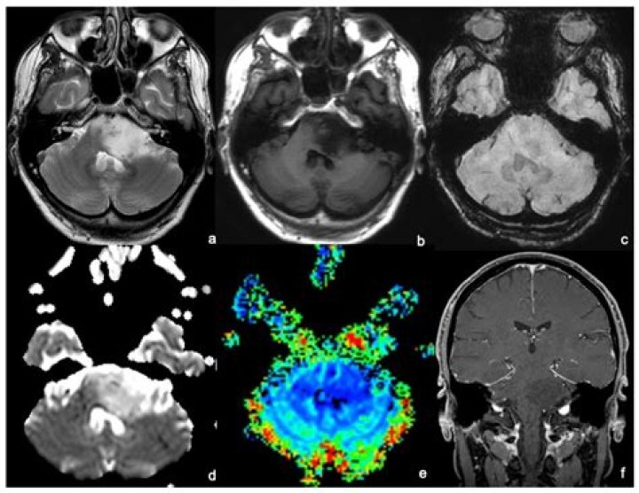 Can you survive brain stem glioma?