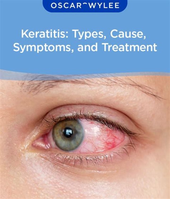 Can you wear contacts with keratitis?