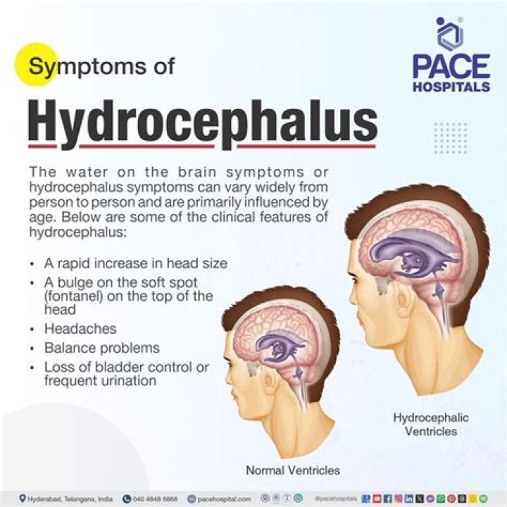 Can you work with hydrocephalus?