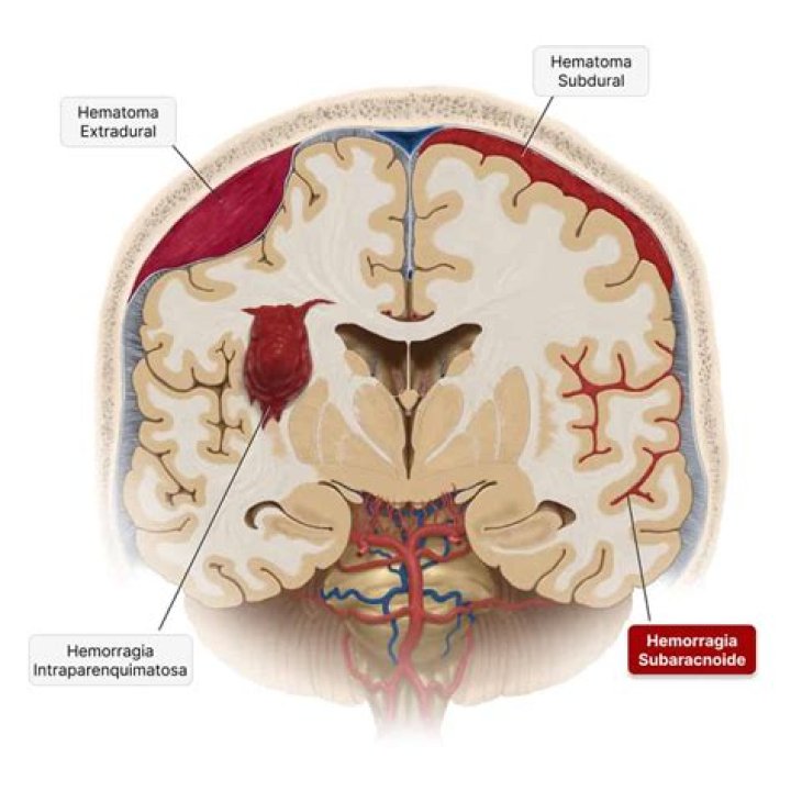 Care este etiologia atrofiei cerebrale difuze?