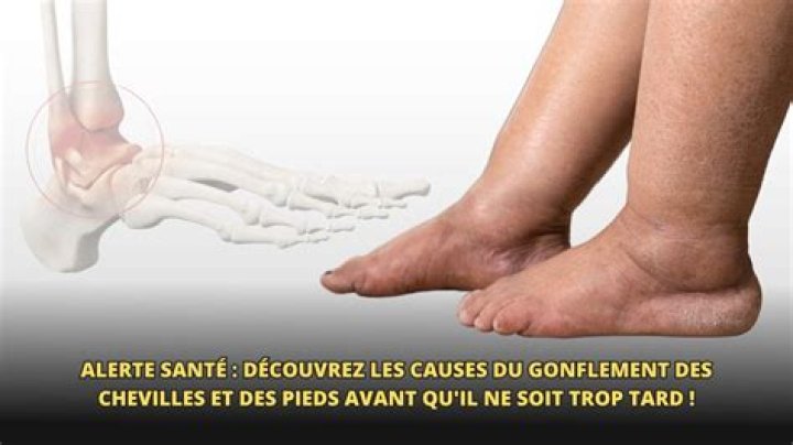 Comment se manifeste la cheville?
