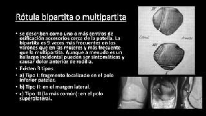 Como se retira la rotula bipartita?