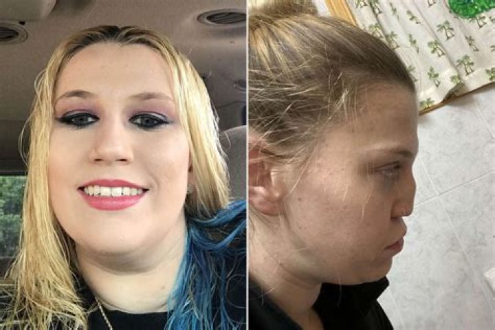 Did Hazel E get her nose fixed?