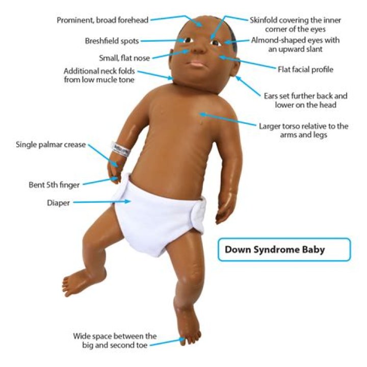 Do babies with Down syndrome have small feet?