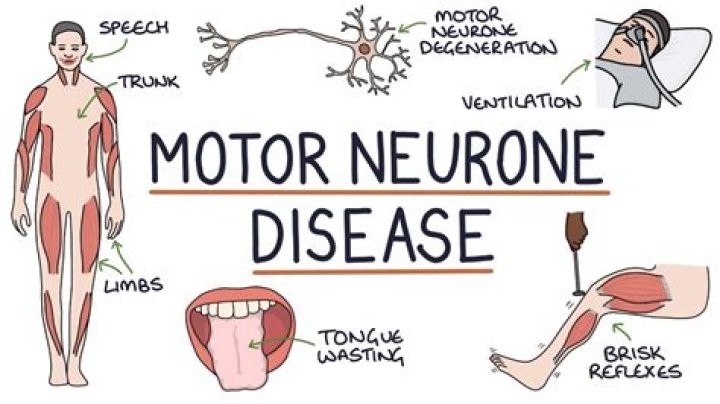 Do motor neurone symptoms come and go?