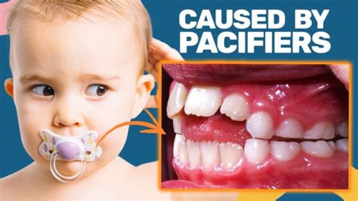 Do pacifiers cause messed up teeth?