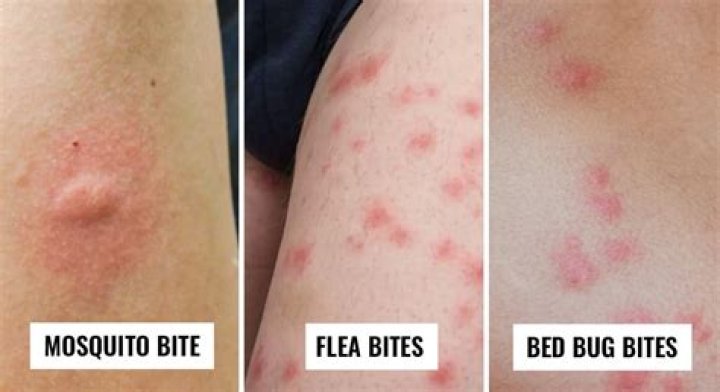 Do shingles ever look like bug bites?