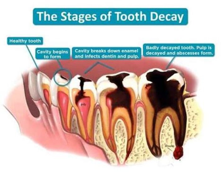 Do strawberries cause tooth decay?