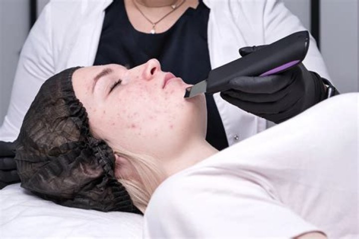 Does a back facial help with acne?