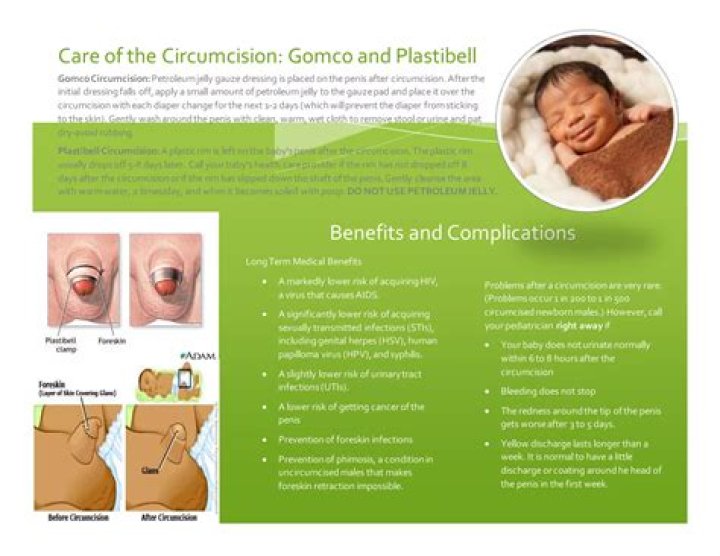 Does a male have to be circumcised at birth?