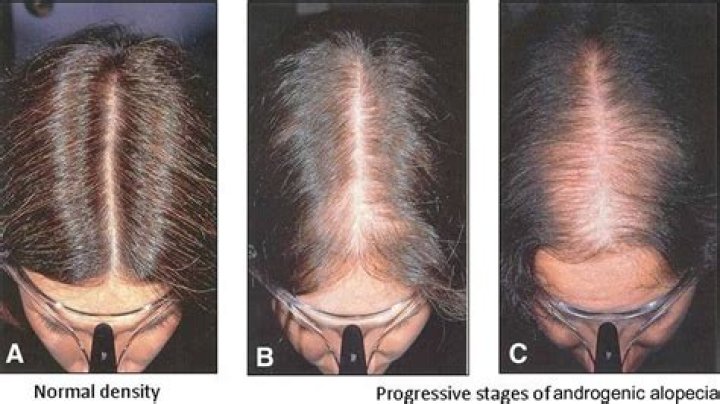 Does androgenetic alopecia stop?