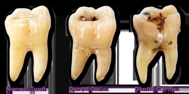 Does black spot on molar mean cavity?