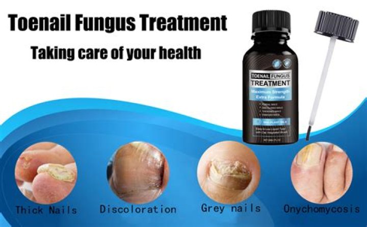 Does canesten work on toenail fungus?