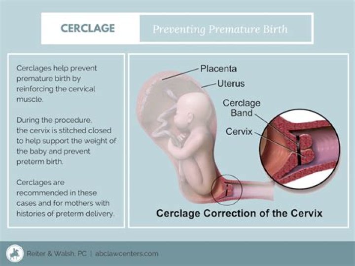 Does cervical cerclage affect baby?
