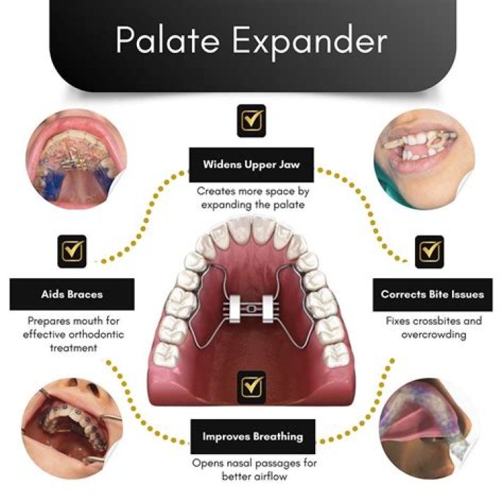 Does expander for braces hurt?