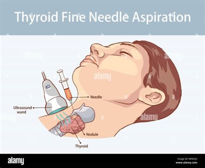 Does FNA hurt?