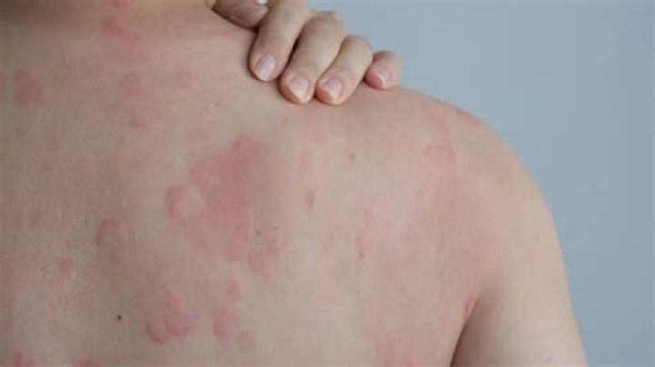 Does insulin cause urticaria?
