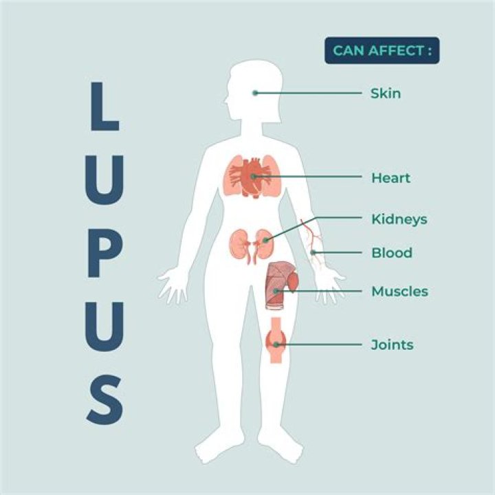 Does lupus affect the lower back?