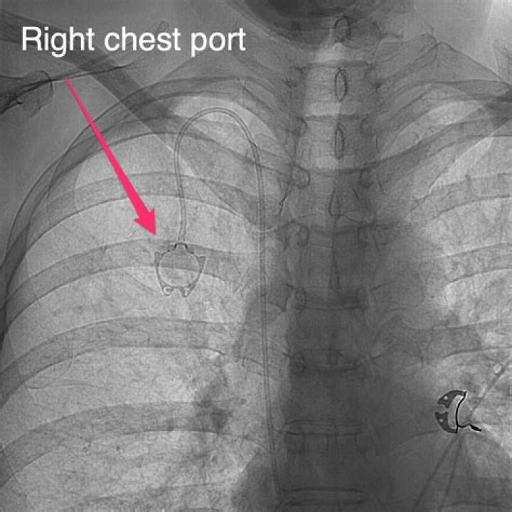 Does lupus show on chest xray?