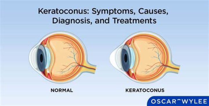 Does Medi-Cal cover keratoconus?
