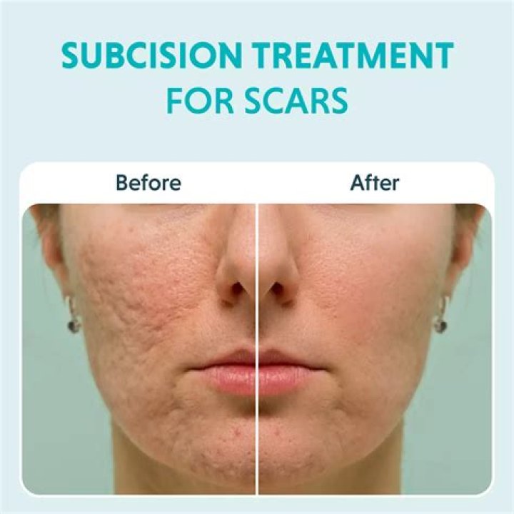 Does microdermabrasion reduce scarring?