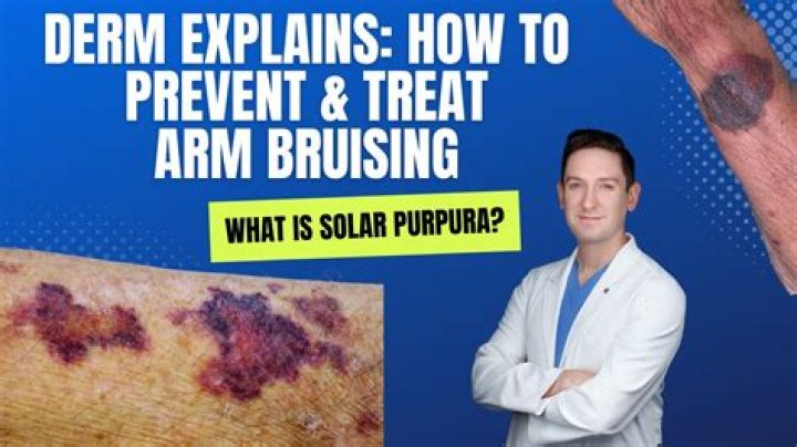 Does pigmented purpuric dermatosis go away?