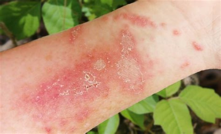 Does poison ivy rash look like bed bug bites?