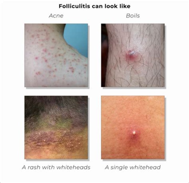 Does pseudofolliculitis barbae go away?