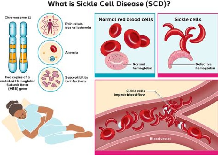 Does sickle cell affect your teeth?