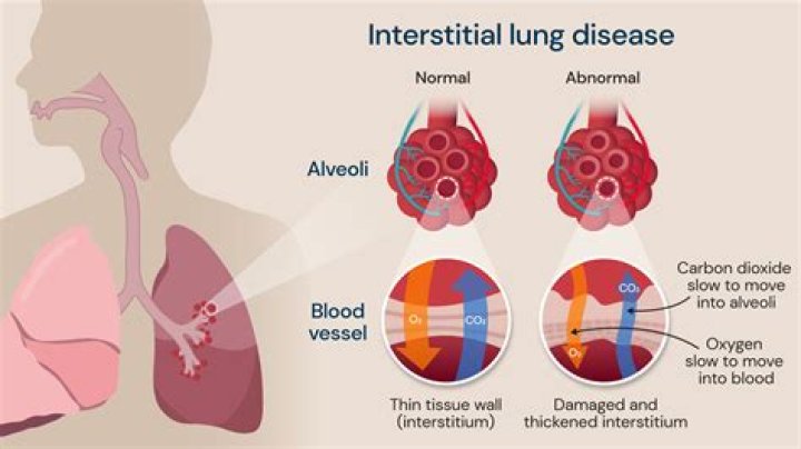 Does smoking cause interstitial lung disease?